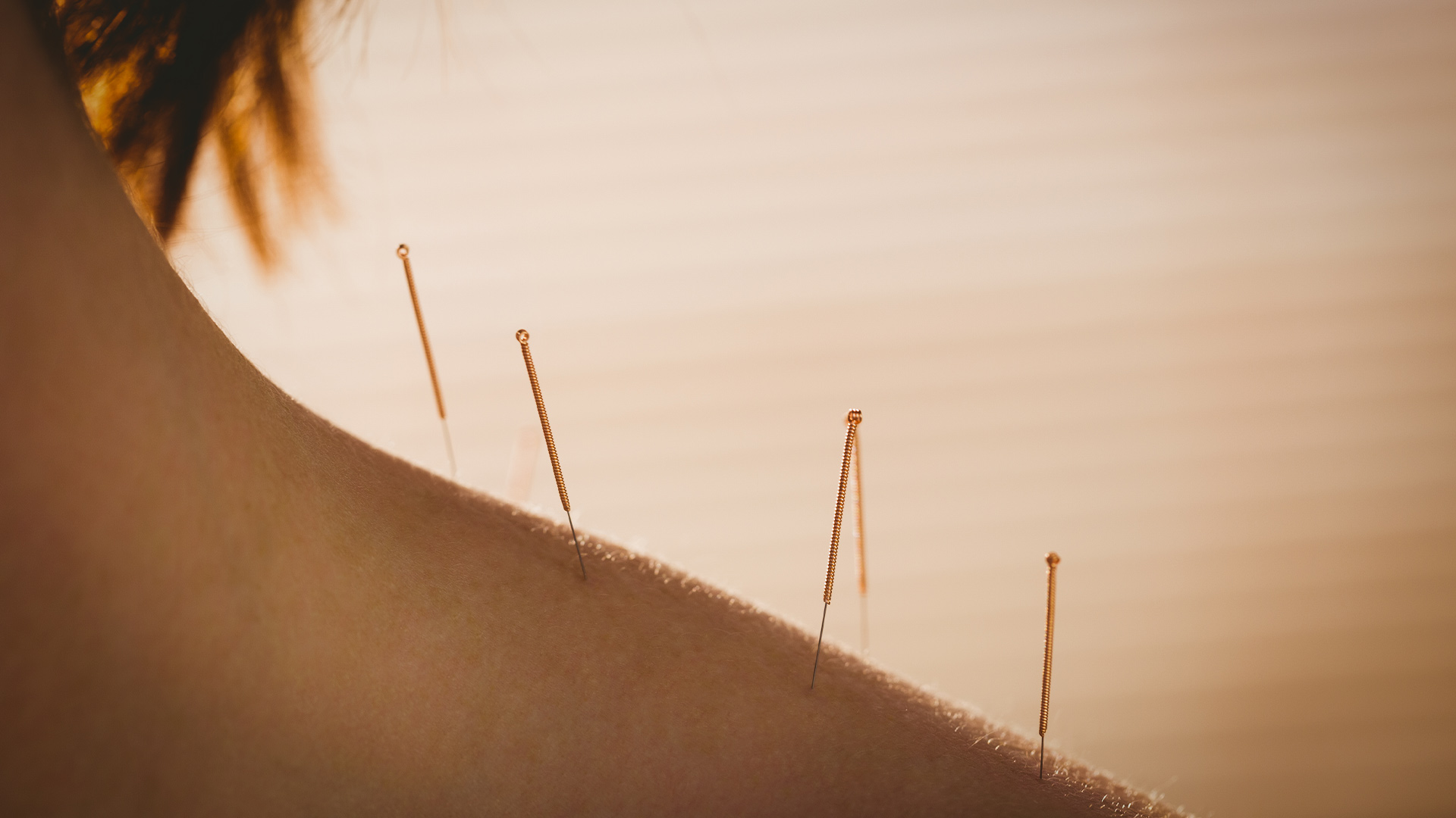 How Holistic Therapies Like Acupuncture Can Combat Age-Related Diseases