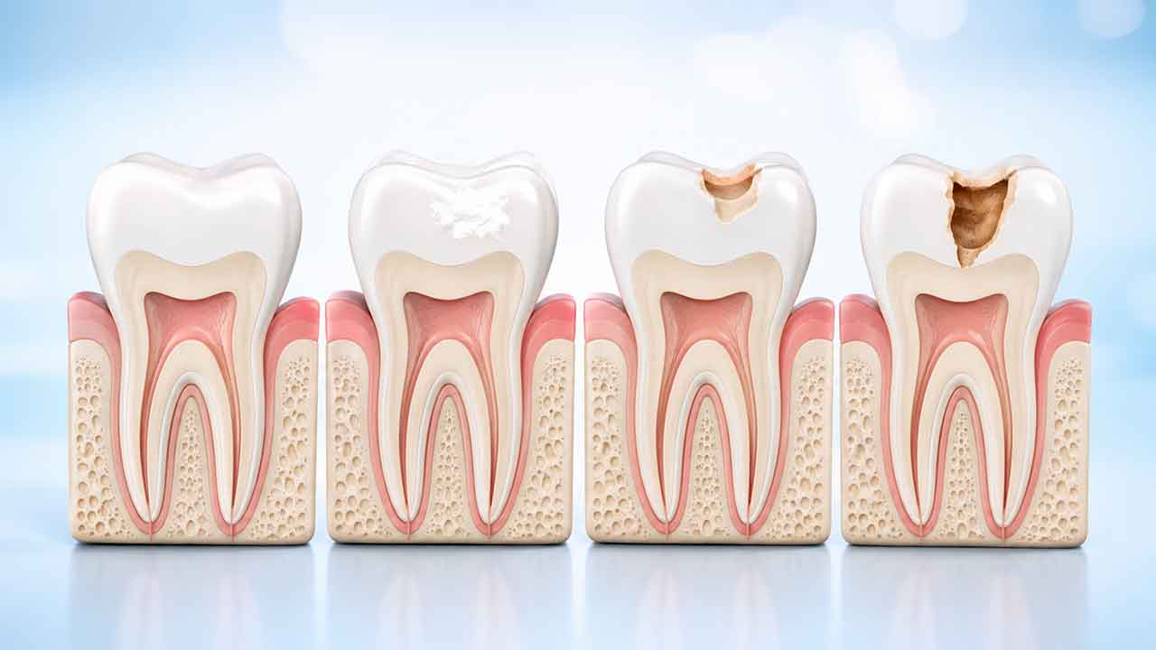 How Tooth Decay Really Progresses: From Early Enamel Changes to a Cavity